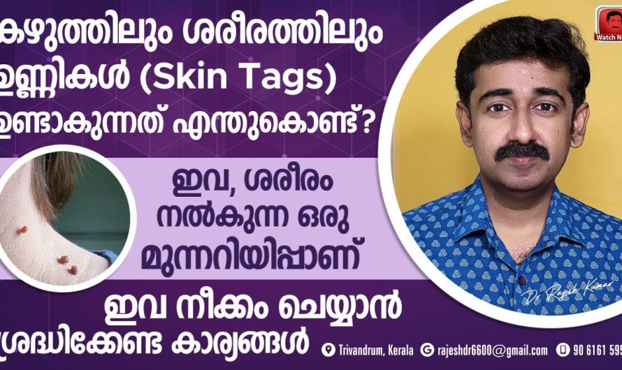 ശരീരത്തിൽ സ്കിൻ ടാഗുകൾ വരാതിരിക്കാനും വന്നവ പരിഹരിക്കാനുള്ള മാർഗങ്ങളെ കുറിച്ച് അറിയാം…