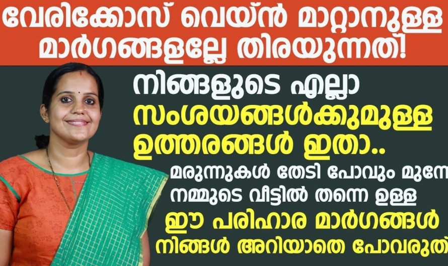 വെരിക്കോസ് വെയിൻ നിങ്ങളുടെ എല്ലാ സംശയങ്ങൾക്കും ഉള്ള ഉത്തരം ഇതാണ്