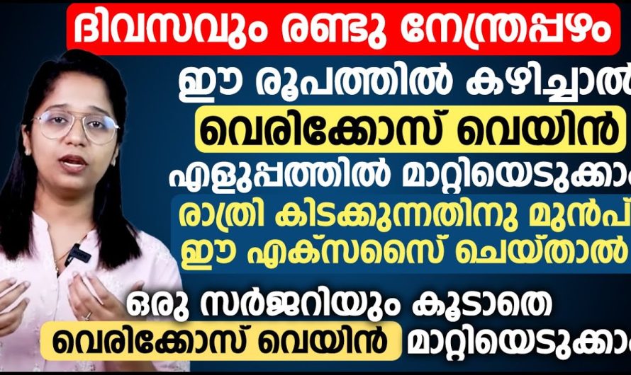 രാത്രി കിടക്കുന്നതിനു മുൻപ് ഈ എക്സസൈസ് ചെയ്താൽ ഒരു സർജറിയും കൂടാതെ വെരിക്കോസ് വെയിൻ മാറ്റാം…