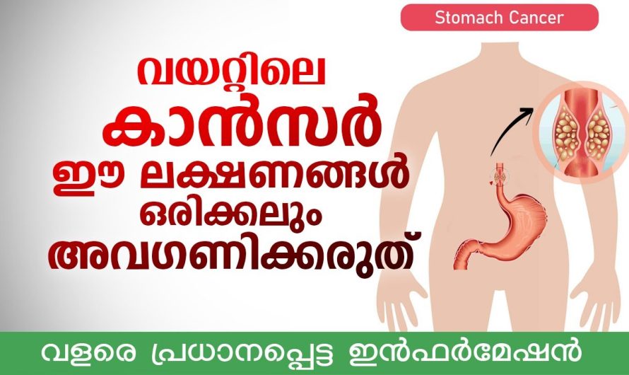 ഉദര സംബന്ധമായ ക്യാൻസറുകൾ വരുന്നതിനു പിന്നിലെ കാരണങ്ങളെ കുറിച്ചും അവയുടെ ലക്ഷണങ്ങളെ കുറിച്ചും മനസ്സിലാക്കാം…