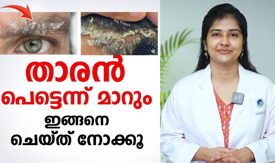 എത്ര വലിയ താരൻ പ്രശ്നങ്ങളും ഈ പറയുന്ന കാര്യങ്ങൾ ശ്രദ്ധിച്ചാൽ ഈസിയായി പരിഹരിക്കാം…