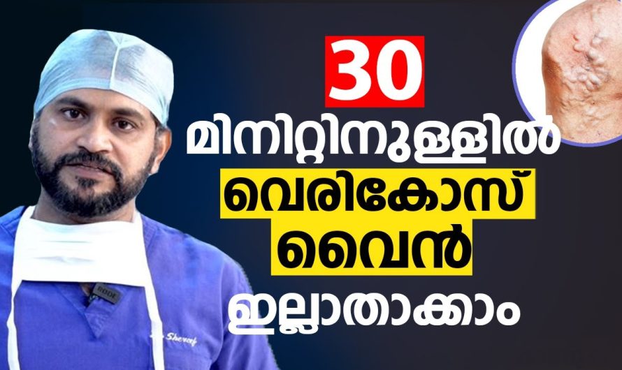 ശസ്ത്രക്രിയയില്ലാതെയും വേദന ഇല്ലാതെയും പെട്ടെന്ന് വെരിക്കോസ് മാറ്റിയെടുക്കാം