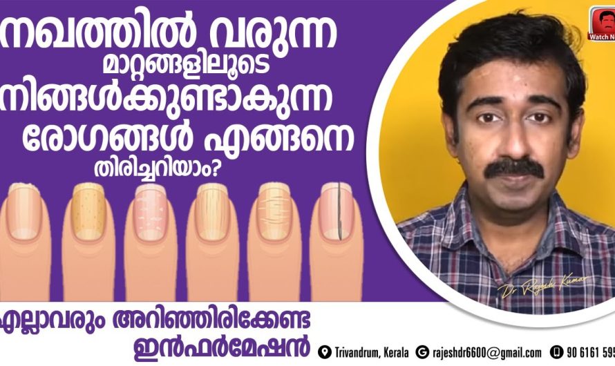 നഖത്തിലുള്ള ചില ലക്ഷണങ്ങൾ മനസ്സിലാക്കി ശരീരത്തിലെ രോഗ സാധ്യതകൾ നേരത്തെ തിരിച്ചറിയാം…