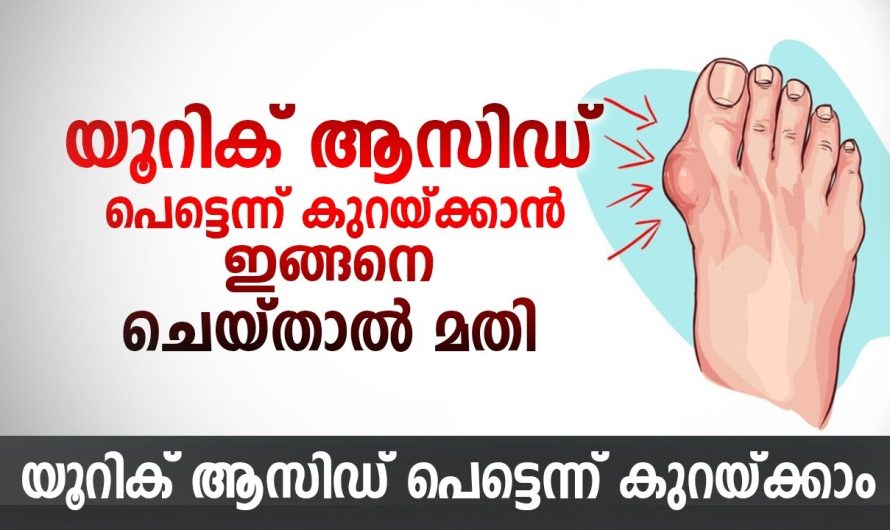 ശരീരത്തിൽ യൂറിക്കാസിഡ് ലെവൽ കൂടുതലുള്ള വ്യക്തികളാണ് എങ്കിൽ അത് കുറയ്ക്കാൻ ഈ ഒരു കാര്യം ശ്രദ്ധിച്ചാൽ മതി…