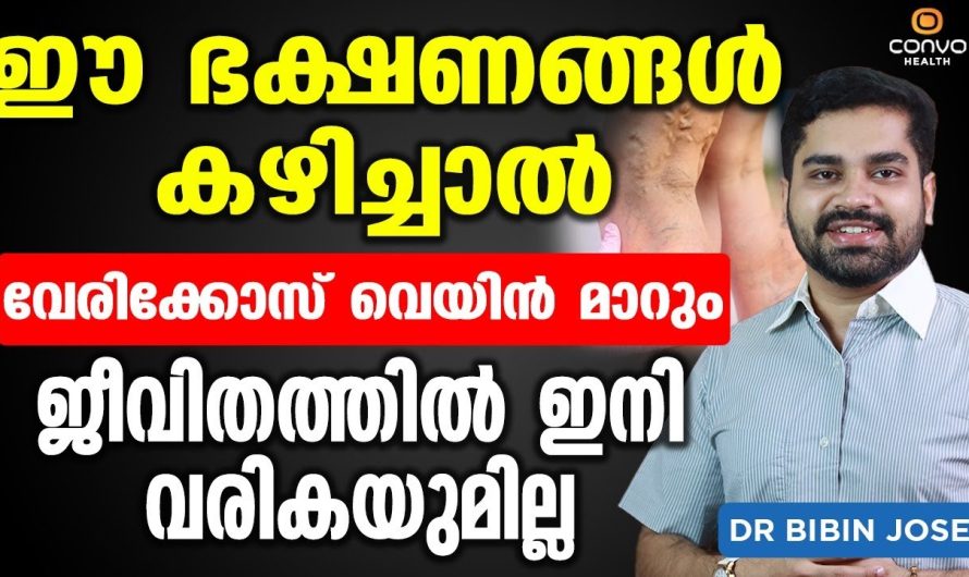 ഈ പറയുന്ന കാര്യങ്ങൾ ജീവിതരീതിയിലും ഭക്ഷണരീതിയിലും ശ്രദ്ധിച്ചാൽ വെരിക്കോസ് വെയിൻ എന്നുള്ള പ്രശ്നത്തെ പൂർണമായും മാറ്റിയെടുക്കാം…