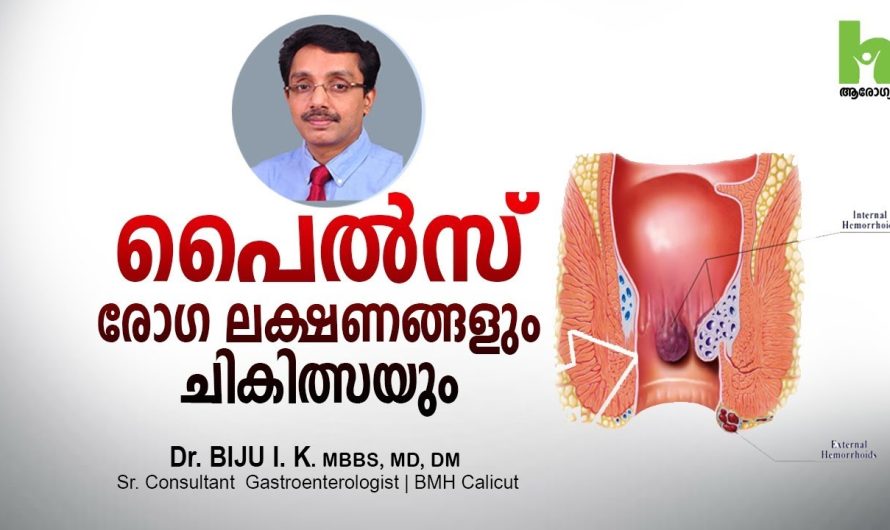 പൈൽസ് എന്ന രോഗത്തെക്കുറിച്ചും ആളുകൾക്കിടയിൽ ഈ രോഗത്തെക്കുറിച്ചുള്ള തെറ്റിദ്ധാരണകളെക്കുറിച്ചും മനസ്സിലാക്കാം…