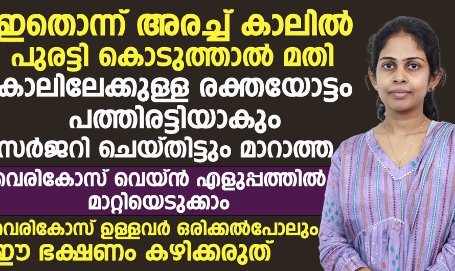 എന്തൊക്കെ മാർഗ്ഗങ്ങൾ പരീക്ഷിച്ചിട്ടും വെരിക്കോസ് വെയിൻ പ്രശ്നങ്ങൾ കുറയ്ക്കാൻ കഴിയുന്നില്ലെങ്കിൽ ഈ ഒരു ഇൻഫർമേഷൻ അറിയാതെ പോകരുത്…