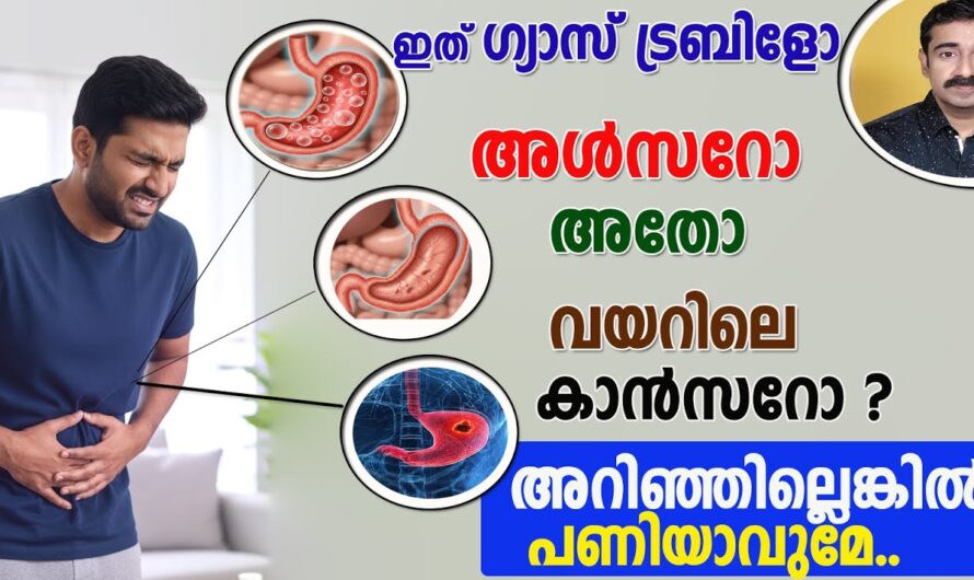 Gas Trouble or Ulcer? How to Recognize?