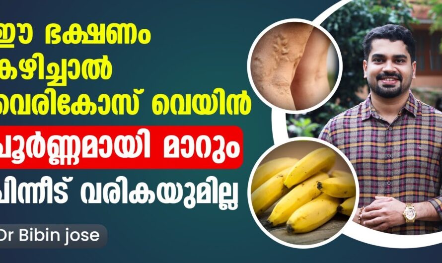 Varicose veins: Why do they occur? Know the main causes