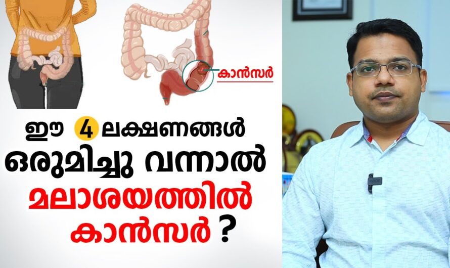 Rectal Cancer: Symptoms and Causes You Should Know
