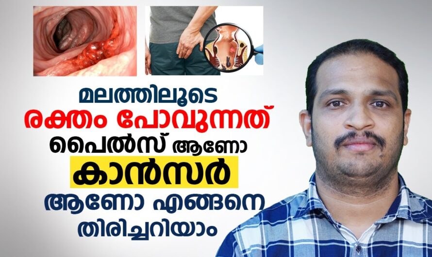 Is blood in the stool a pile? 5 reasons you should know!