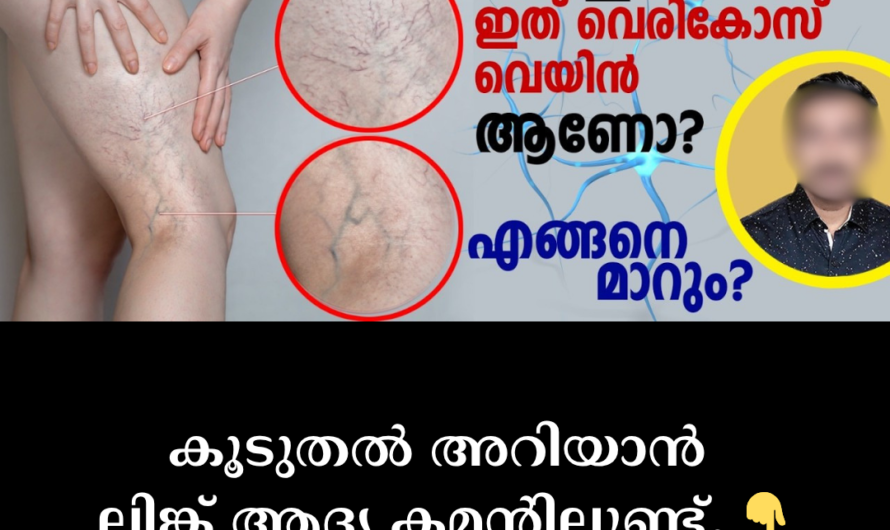 Blue veins in the legs are not just a cosmetic problem! 5 reasons that lead to varicose veins