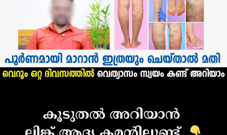 Are the veins in your legs swollen? 5 things that cause varicose veins
