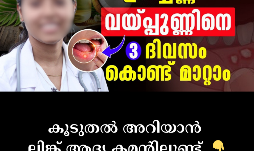 Having trouble eating? 5 main causes of canker sores