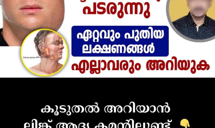 Swelling and fever under the eyes; 5 things to keep in mind to avoid spreading mumps