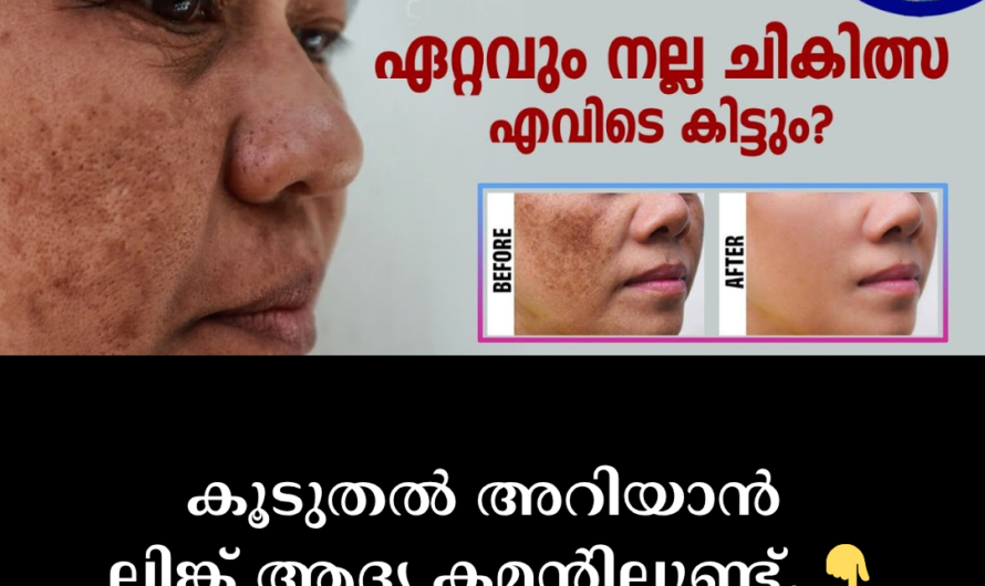 Do dark spots on the face ruin your confidence? 5 main causes