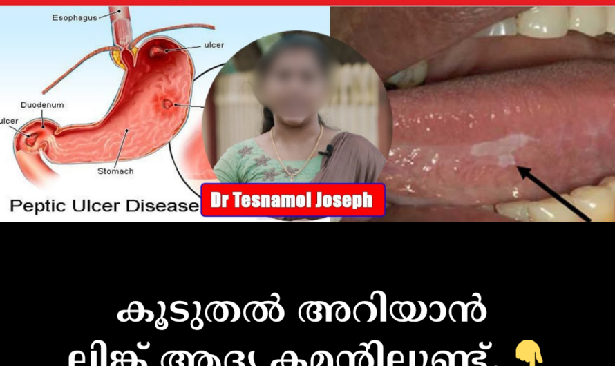 Are you bothered by chronic heartburn and indigestion? 5 main things that cause ulcers
